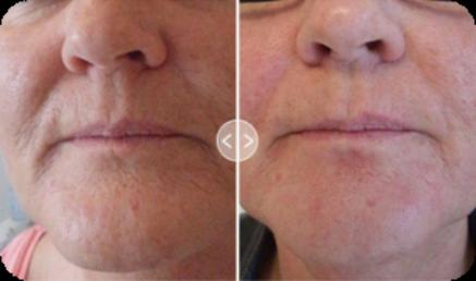 Before and after result around the lower face