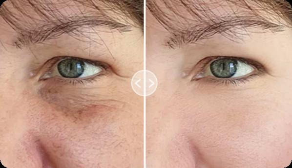 Before and after result around the eye area