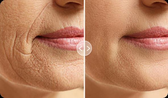 Before and after result around the mouth